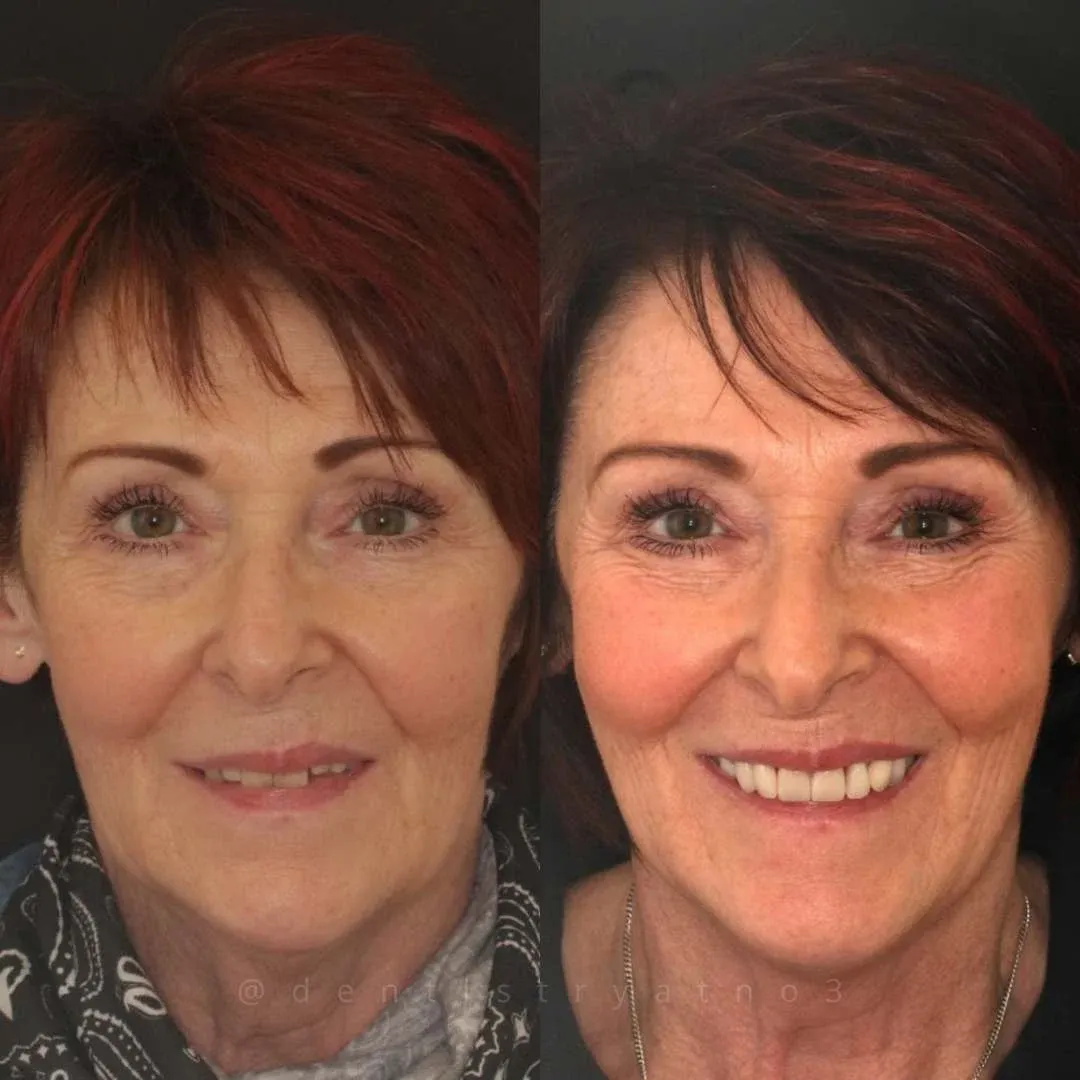 Before and after dental implant treatment with Alisdair Colquhoun