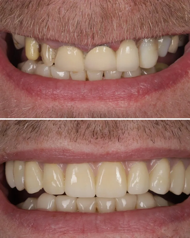 Before & after treatment with Alisdair