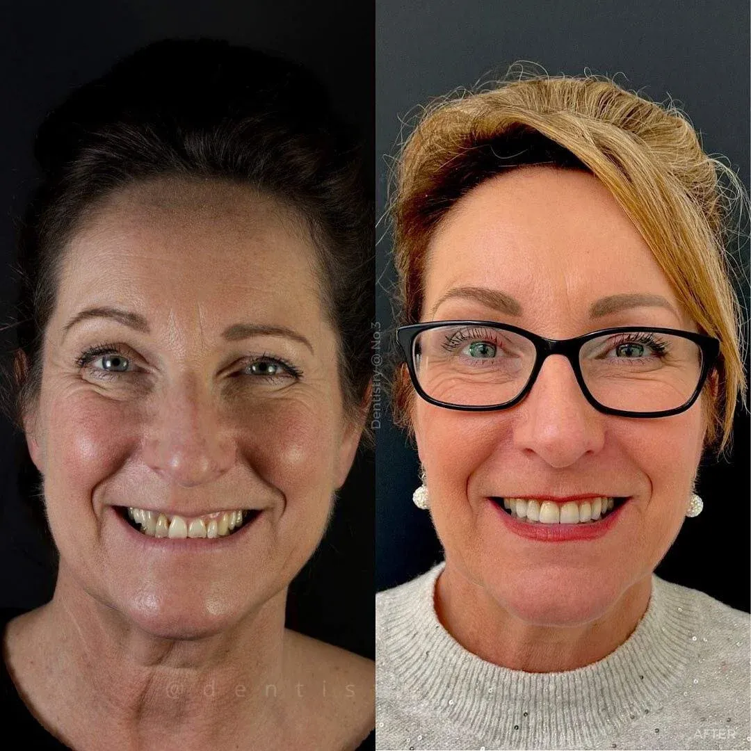 Before and after dental implant treatment with Alisdair Colquhoun