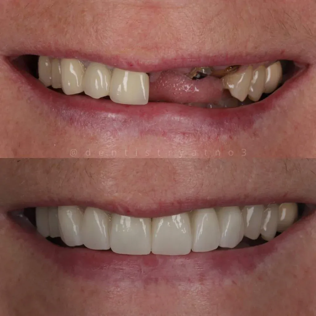 Before and after dental implant treatment with Alisdair Colquhoun