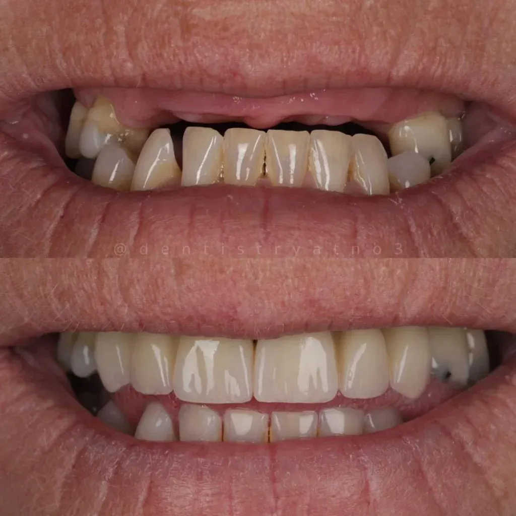 Before and after dental implant treatment with Alisdair Colquhoun